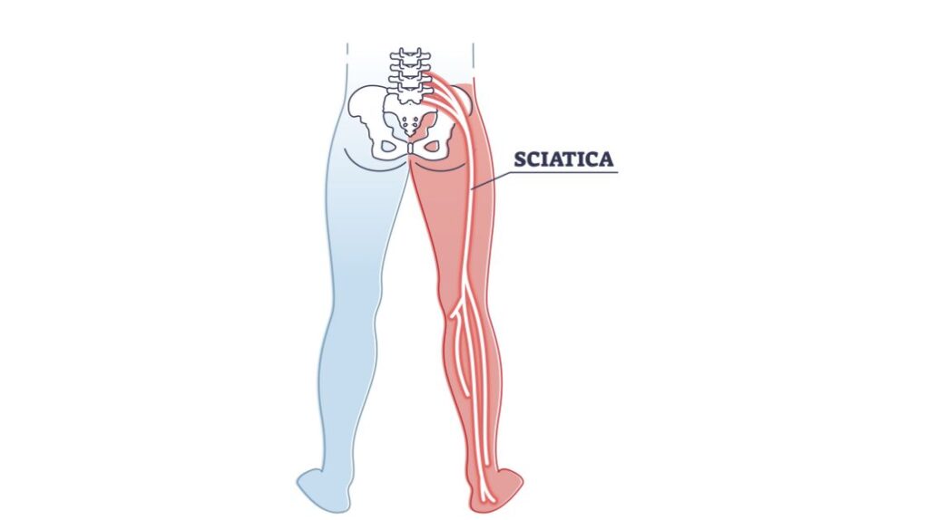 sciatica specialist doctor in indore, sciatica doctor in indore, sciatica treatment in indore, spine specialist in indore, best spine doctor in indore, spine doctor in indore