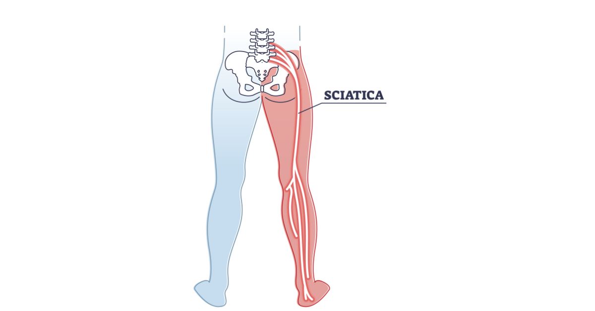 sciatica treatment in indore