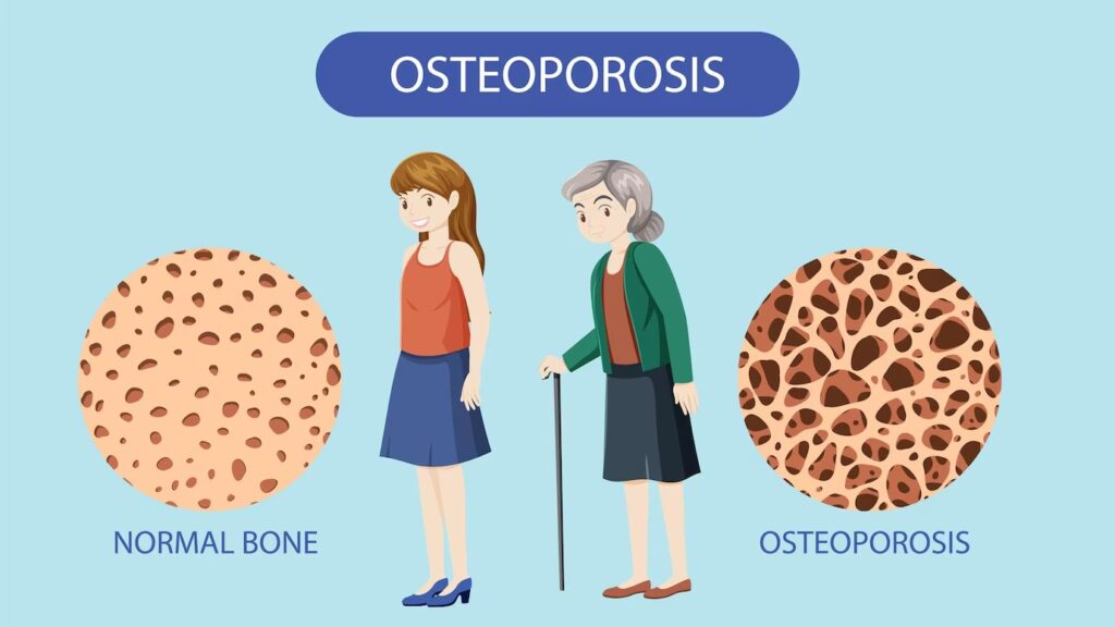 Osteoporosis Treatment in Indore